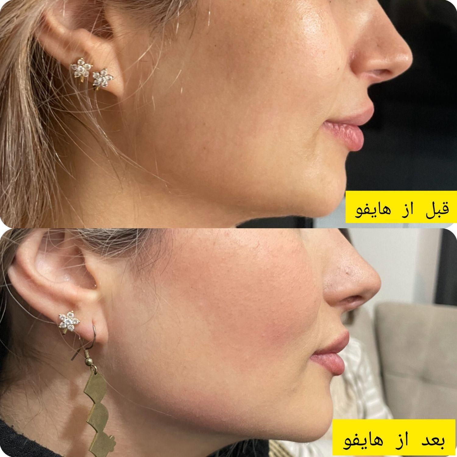 لیزر موی زائدفوق قوی الکساندرایت امریکایی درمهرشهر|خدمات آرایشگری و زیبایی|کرج, فاز ۲ مهرشهر|دیوار