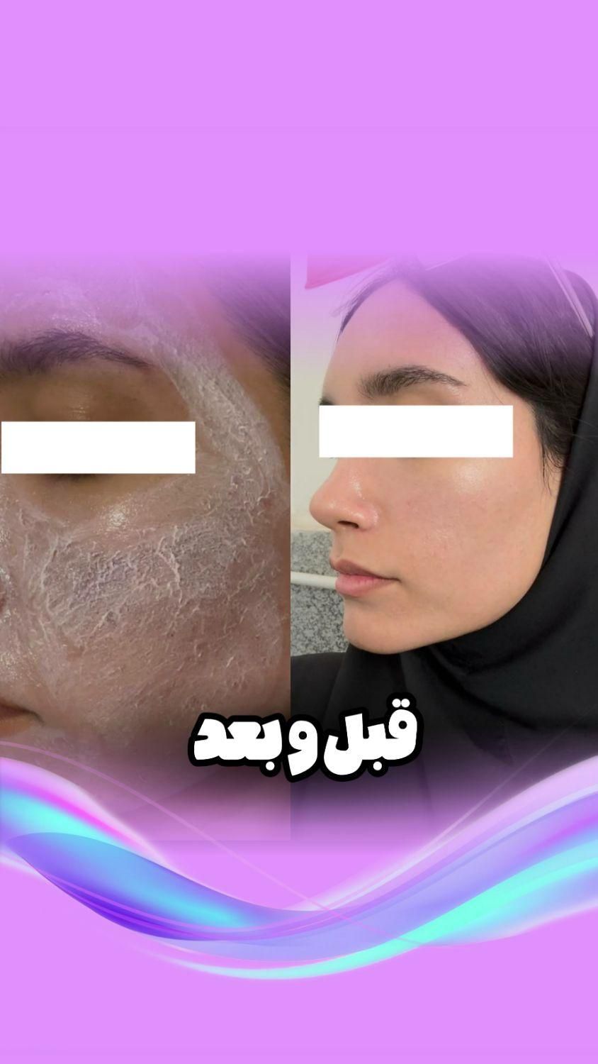 فیشال و پاکسازی پوست|خدمات آرایشگری و زیبایی|اصفهان, خواجو|دیوار