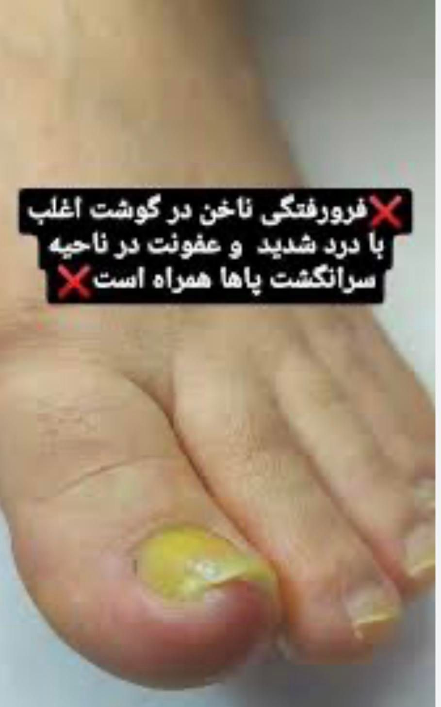 ارتونیل ناخن(ناخن فرورفته در گوشت) درمان عفونت|خدمات آرایشگری و زیبایی|اصفهان, طامه|دیوار