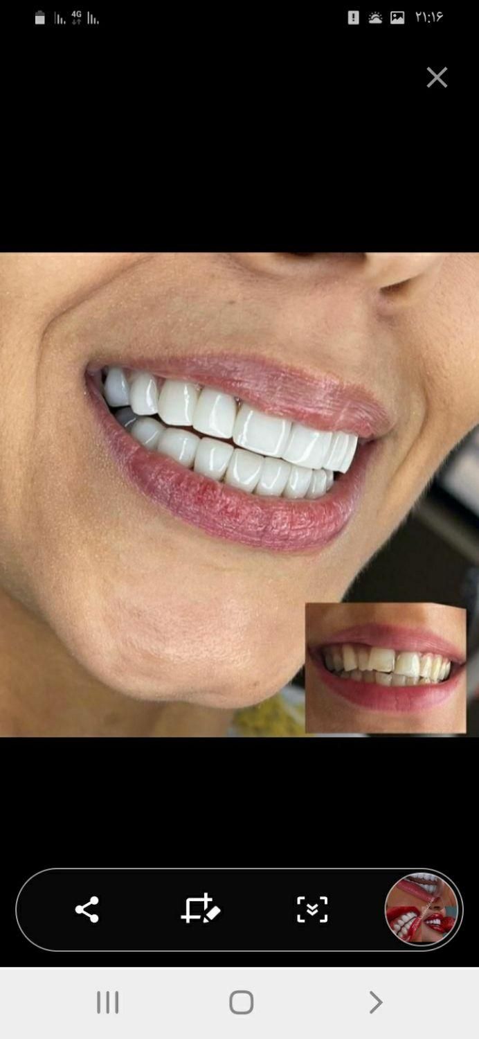 آفرلمینت‌دندان‌وروکش|خدمات آرایشگری و زیبایی|تهران, شهرک ولیعصر جنوبی|دیوار