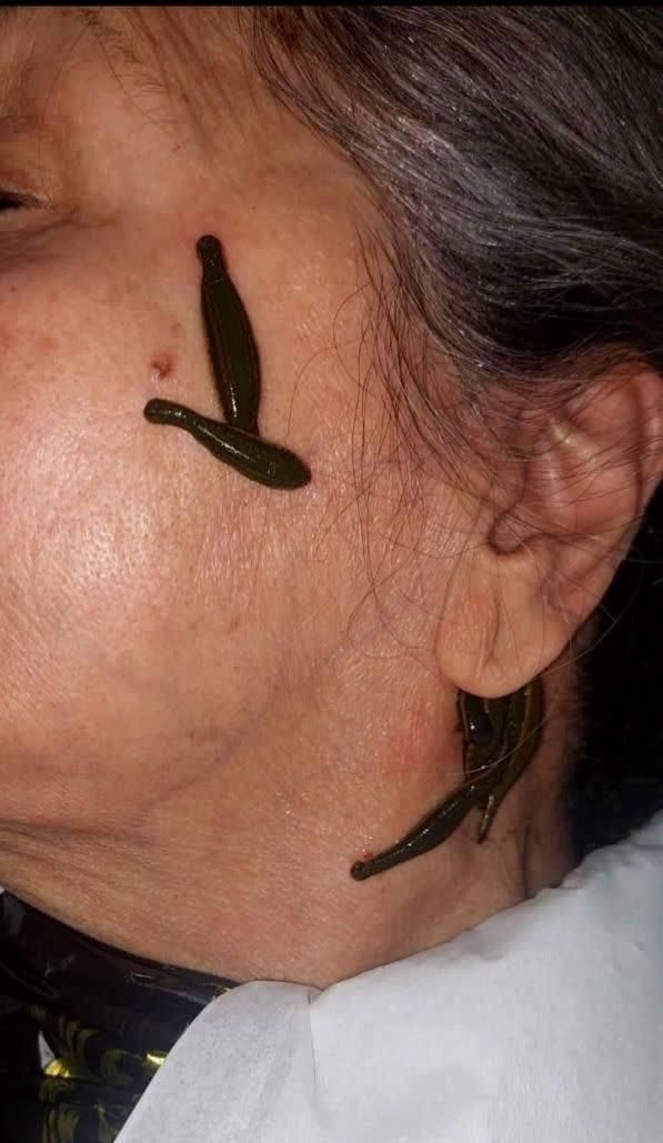 زگیل تناسلی حجامت بادکش فصدخون زالو درمانی طب سوزن|خدمات آرایشگری و زیبایی|اصفهان, خانه اصفهان|دیوار