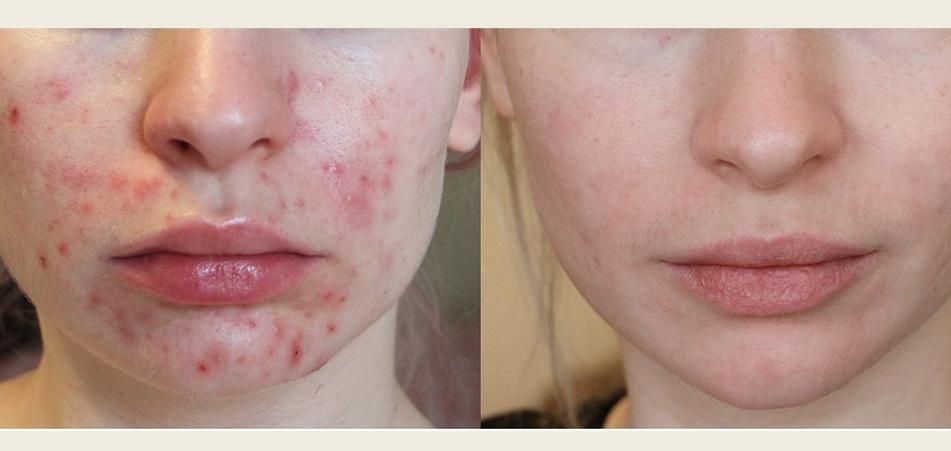 جوش و تیرگی صورت ، ریزش مو ، جوانسازی پوست|خدمات آرایشگری و زیبایی|رفسنجان, |دیوار