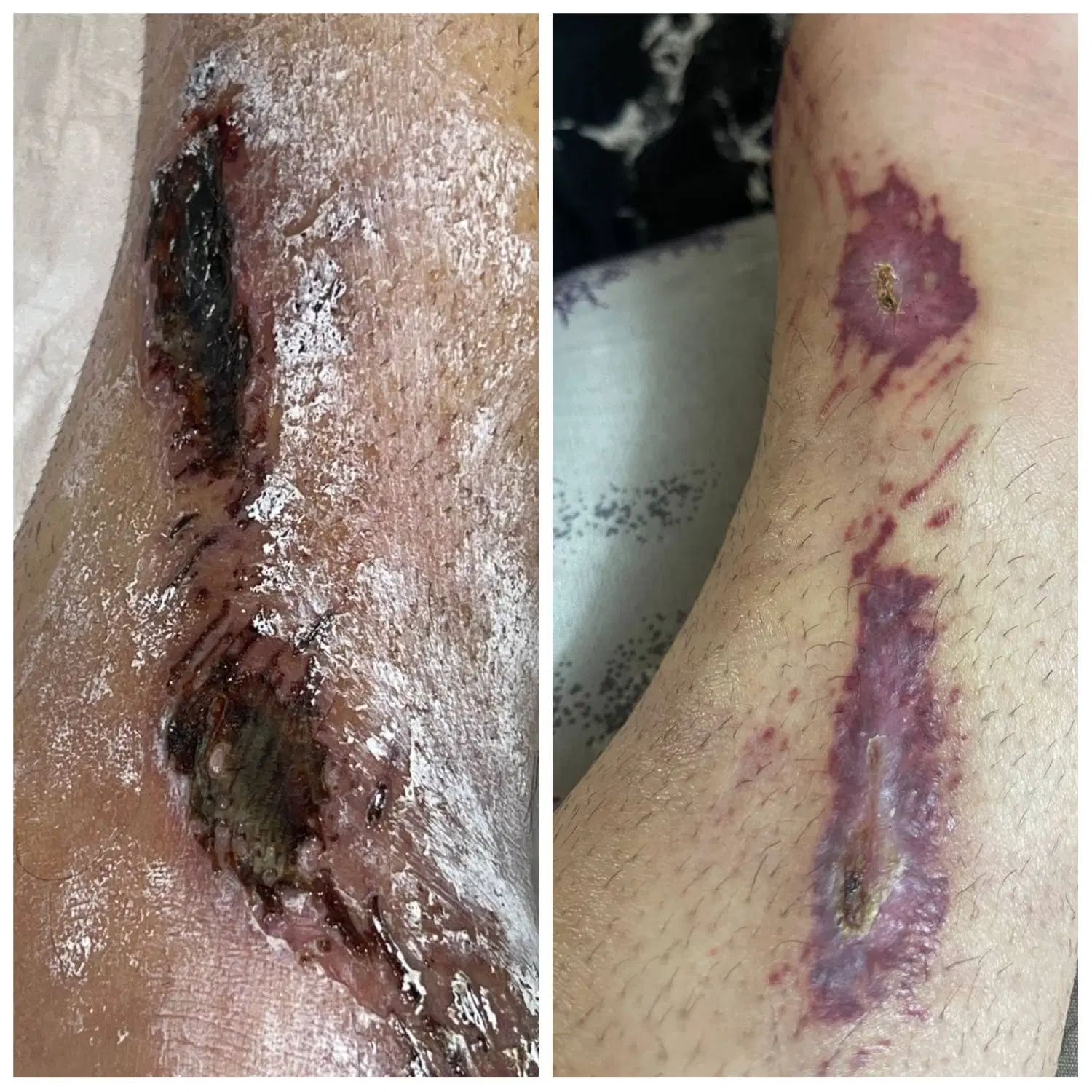 ترمیم زخم قطعی به شیوه نوین باقیمت ارزان|خدمات آرایشگری و زیبایی|اصفهان, سلطان‌آباد|دیوار