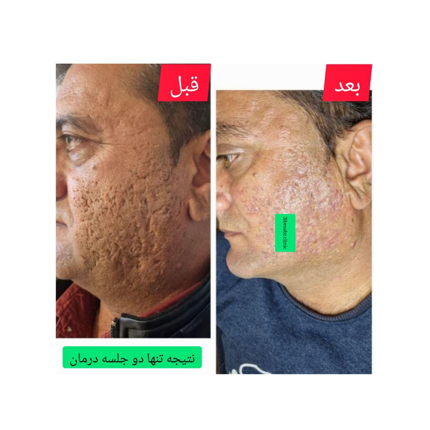 درمان تضمینی وماندگار تو رفتگی پوستی/جای جوش/اسکار|خدمات آرایشگری و زیبایی|اصفهان, باغ دریاچه|دیوار
