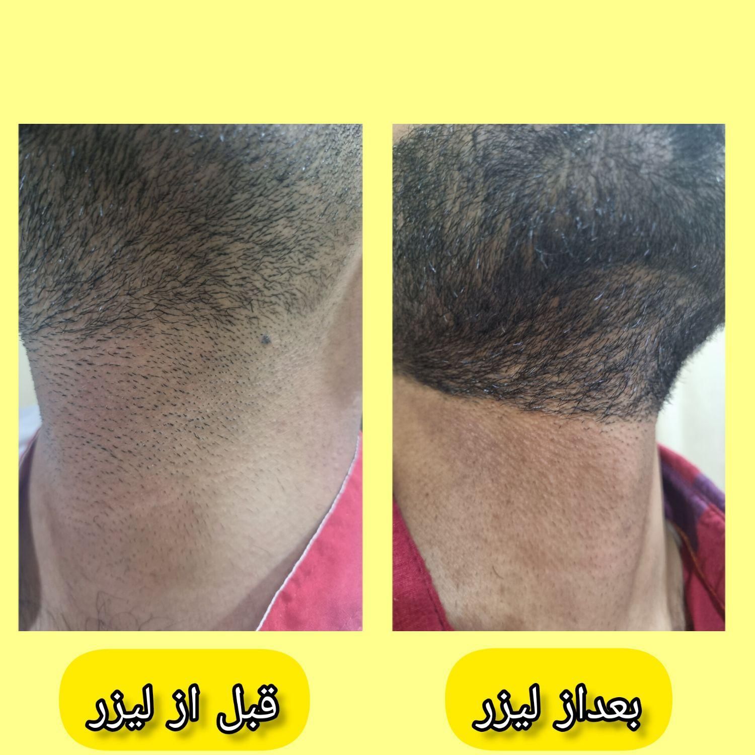 کلینیک تخصصی لیزر موهای زائد(الکساندرایت آمریکای)|خدمات آرایشگری و زیبایی|خرمشهر, |دیوار