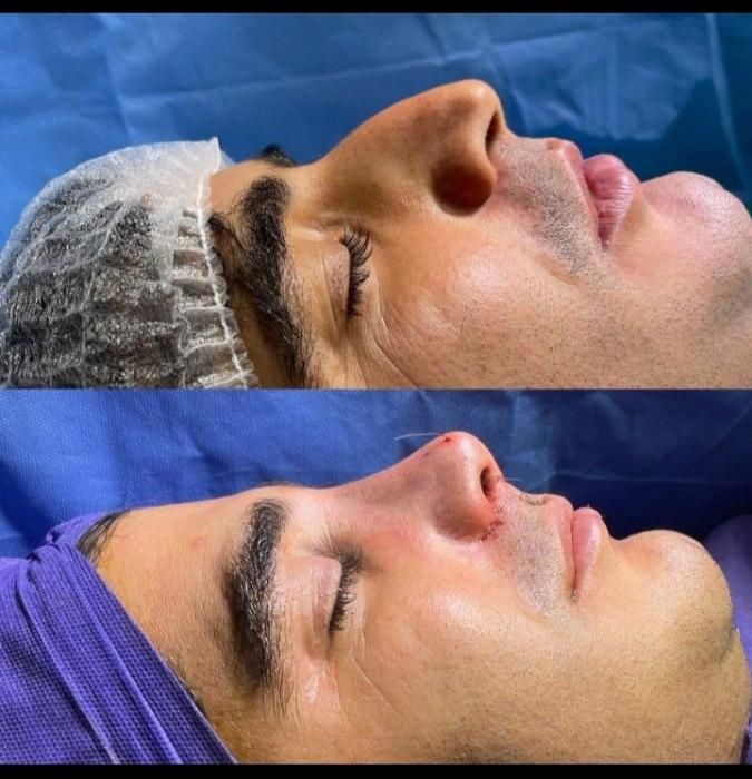 جراحی بینی ابدو،چربی لیپو 360ترانسفر باسن بیکینی|خدمات آرایشگری و زیبایی|اندیشه, اندیشه فاز ۱|دیوار