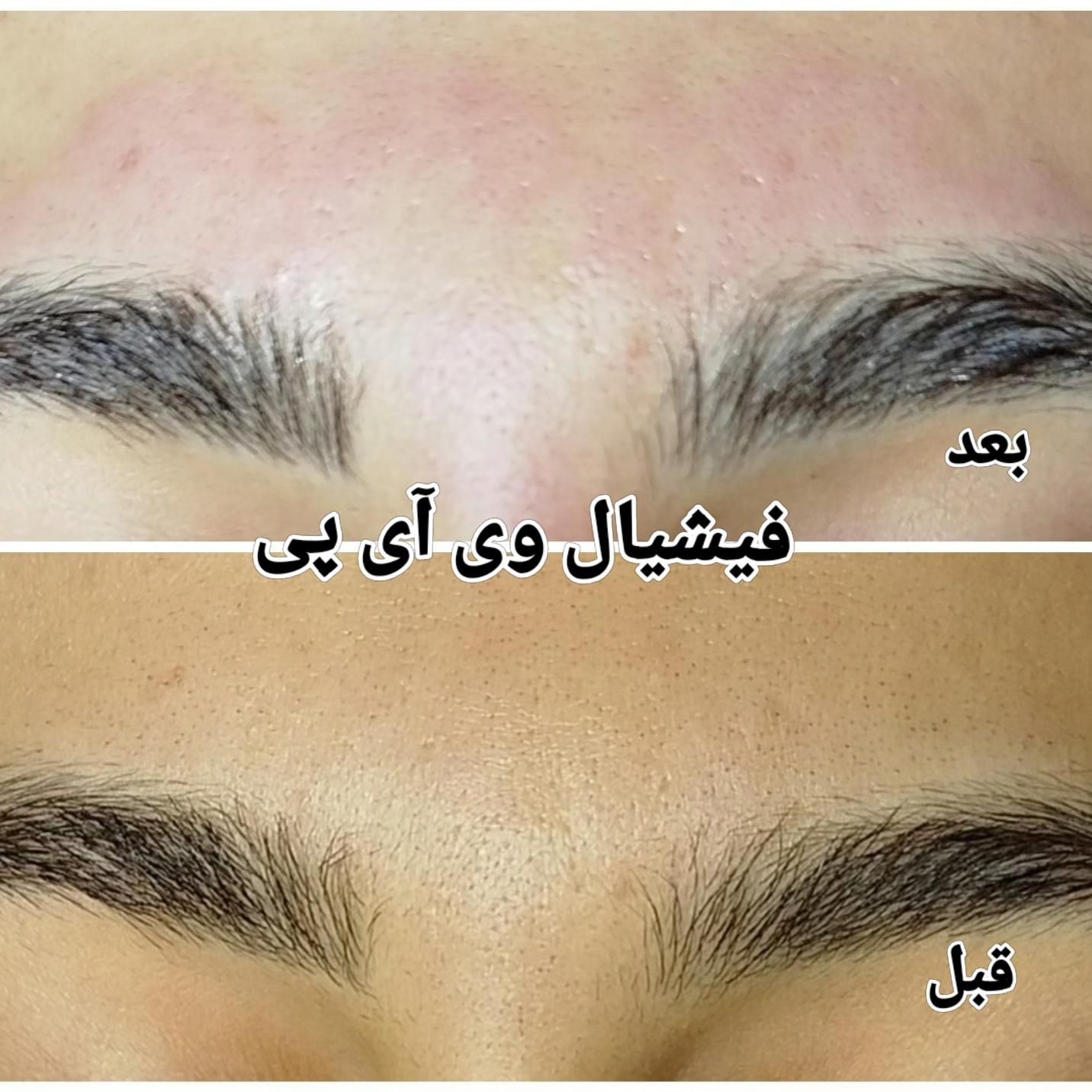 جشنواره تخفیف ویژه لیزر،ژل،بوتاکس،کلیه خدمات پزشکی|خدمات آرایشگری و زیبایی|ساری, |دیوار