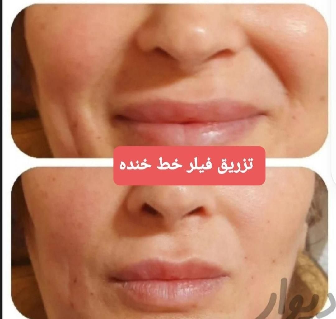 تزریق چربی صورت،ژل،بوتاکس،لیزر،لاغری|خدمات آرایشگری و زیبایی|رشت, گلسار|دیوار