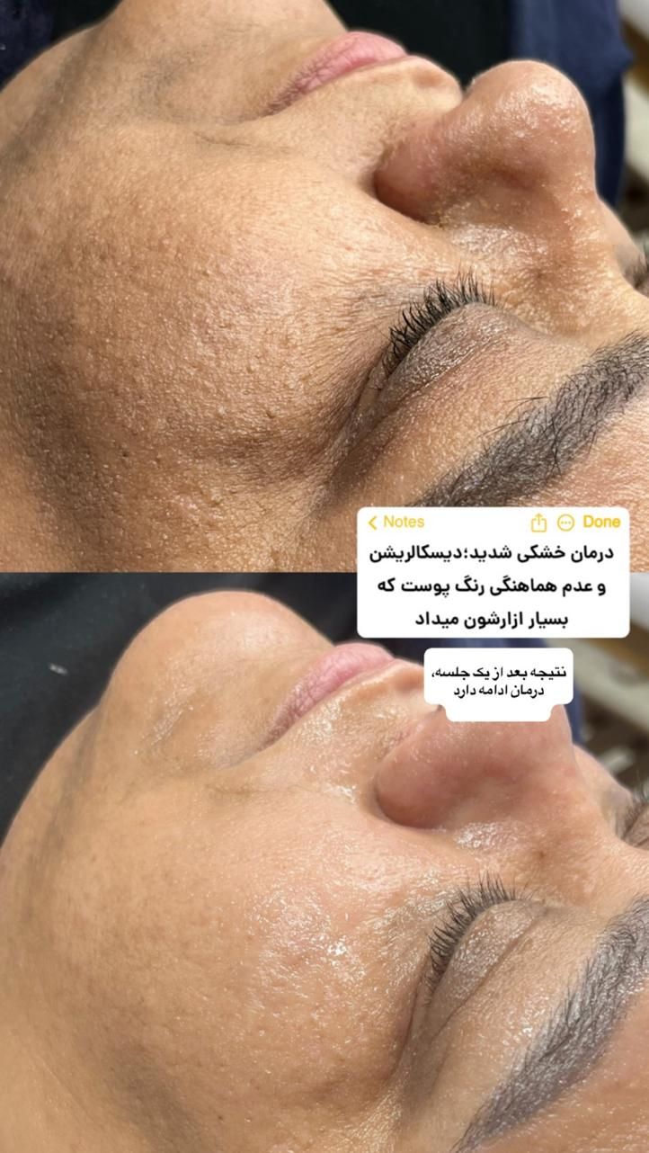 فیشال و خدمات تخصصی پوست توسط پیراپزشک در مطب پزشک|خدمات آرایشگری و زیبایی|مشهد, سجاد شهر|دیوار