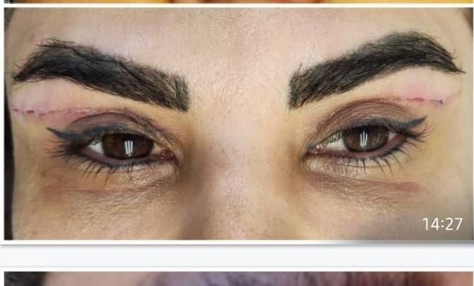 جشنواره بلفارو پلاستی چشم گربه ای جراحی پلک|خدمات آرایشگری و زیبایی|اصفهان, مسجد مصلی|دیوار