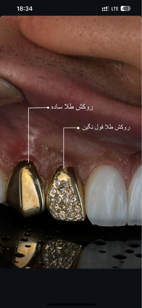 روکش طلا انواع کامپوزیت بلیچینگ لمینیت|خدمات آرایشگری و زیبایی|تهران, صادقیه|دیوار