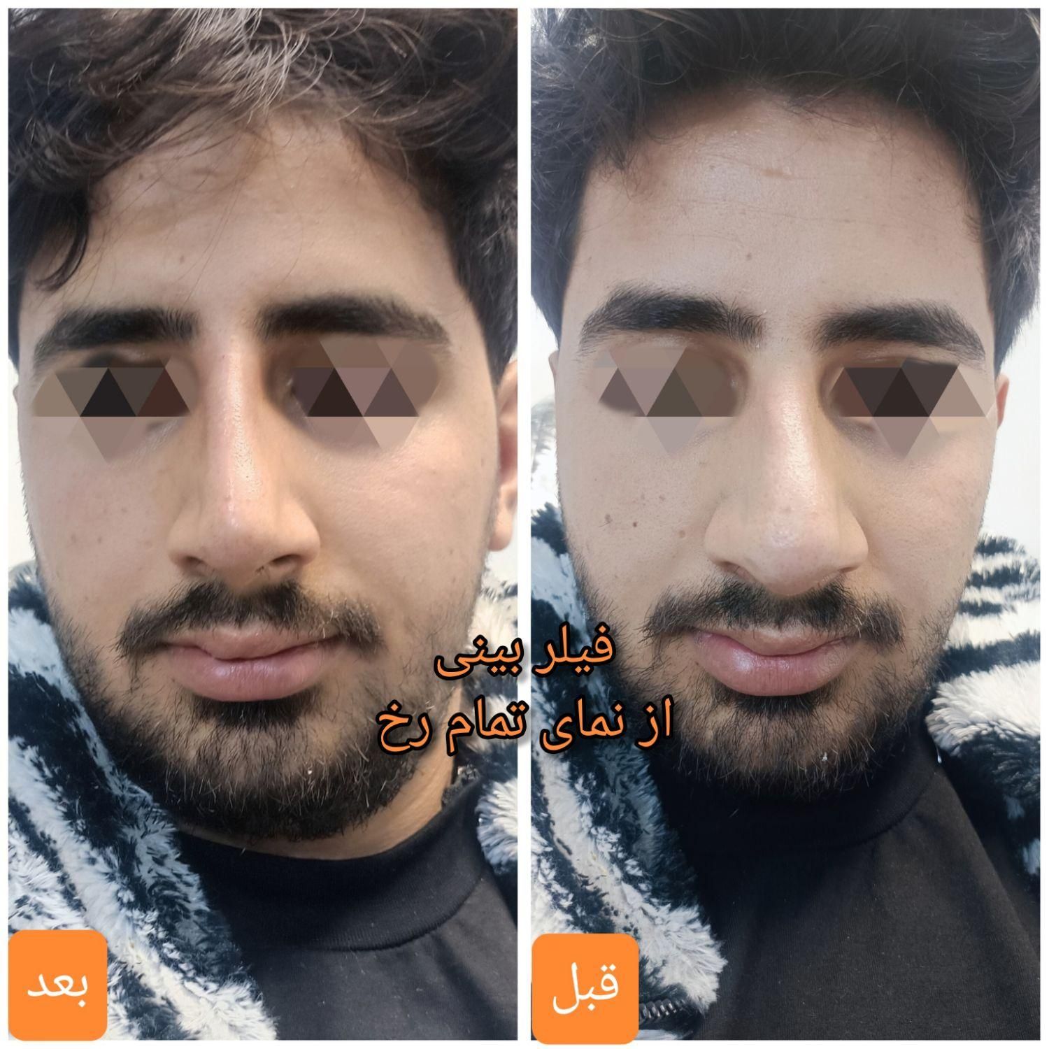 تزریق آنزیم بینی/فیلر بینی/شقیقه/ژل/درکلینیک پزشکی|خدمات آرایشگری و زیبایی|شیراز, زرهی|دیوار