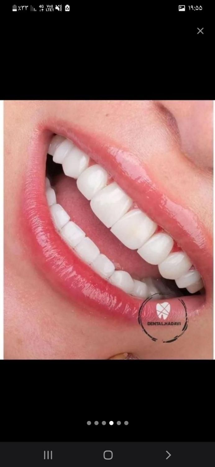 آموزش دندانپزشکی و کامپوزیت . لمینت .ترمیم|خدمات آموزشی|اسلام‌شهر, |دیوار