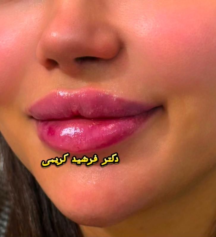 بوتاکس مصپورت فقط۴۹۰ کلینیک زیبایی دکتر فرشیدکریمی|خدمات آرایشگری و زیبایی|کرمانشاه, |دیوار