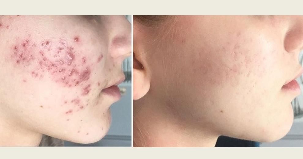 جوش و تیرگی صورت ، ریزش مو ، جوانسازی پوست|خدمات آرایشگری و زیبایی|رفسنجان, |دیوار
