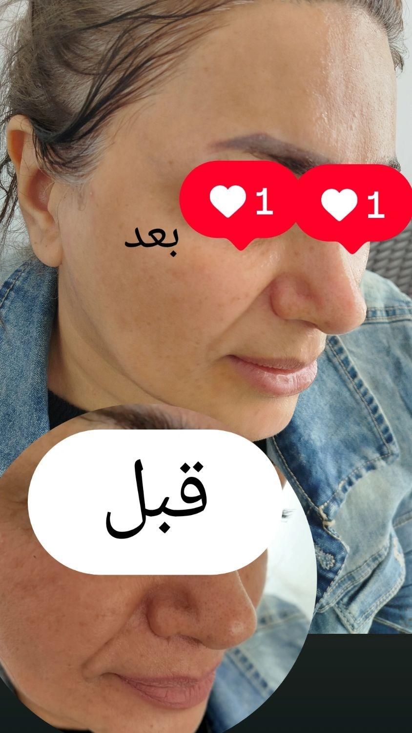 فیشیال تخصصی پوست|خدمات آرایشگری و زیبایی|گلبهار, |دیوار