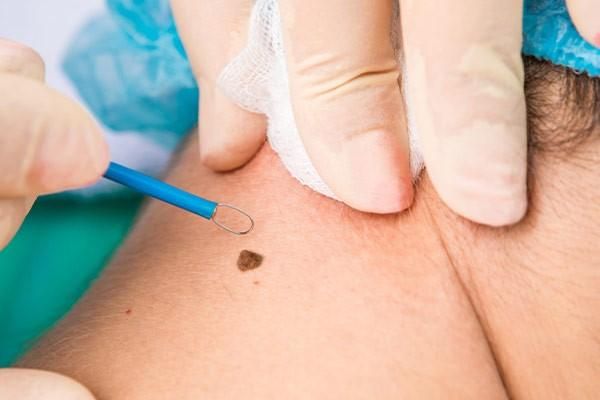 خالبرداری بدون جراحی در کلینیک زیبایی و لیزر راویس|خدمات آرایشگری و زیبایی|کاشان, رجایی|دیوار