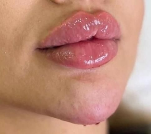 تزریق ژل فیلر بوتاکس مزوژل|خدمات آرایشگری و زیبایی|مشهد, طبرسی شمالی|دیوار
