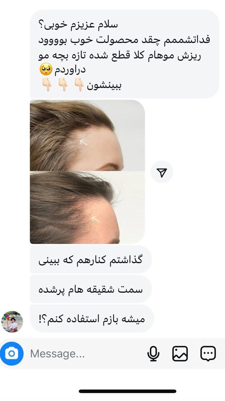 قطع ریزش مو و رویش مجدد مو|آرایشی، بهداشتی، درمانی|تهران, حسین‌آباد|دیوار