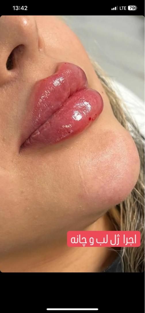 تزریق ژل و بوتاکس جشنواره|خدمات آرایشگری و زیبایی|تهران, عبدل‌آباد|دیوار