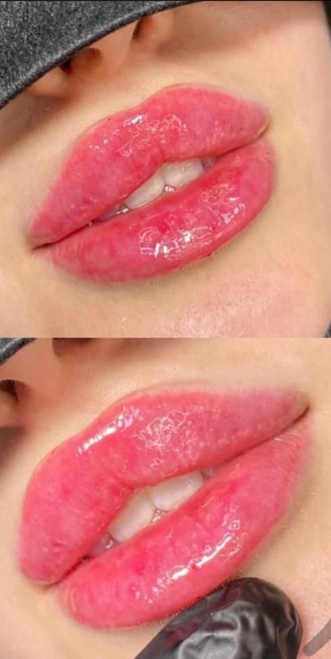 ژل بوتاکس فیلرمادلینگ هایفو لیزر فشیال مطب سلامت|خدمات آرایشگری و زیبایی|تبریز, |دیوار