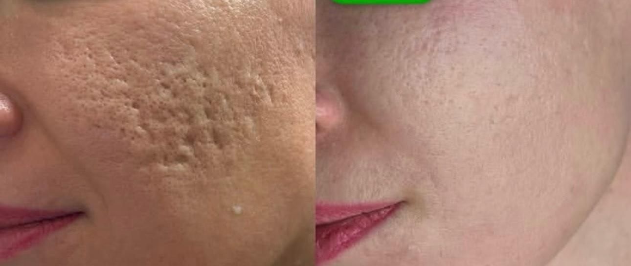 کلینیک پوست/درمان لک/جوش جای جوش/مزونیدلینگ/فشیال|خدمات آرایشگری و زیبایی|مشهد, فرهنگ|دیوار