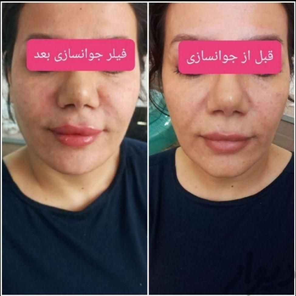 سابسیژن فیلر اندولیفت ژل بادی هایفو مزو بوتاکس|خدمات آرایشگری و زیبایی|کرج, مهرویلا جنوبی|دیوار
