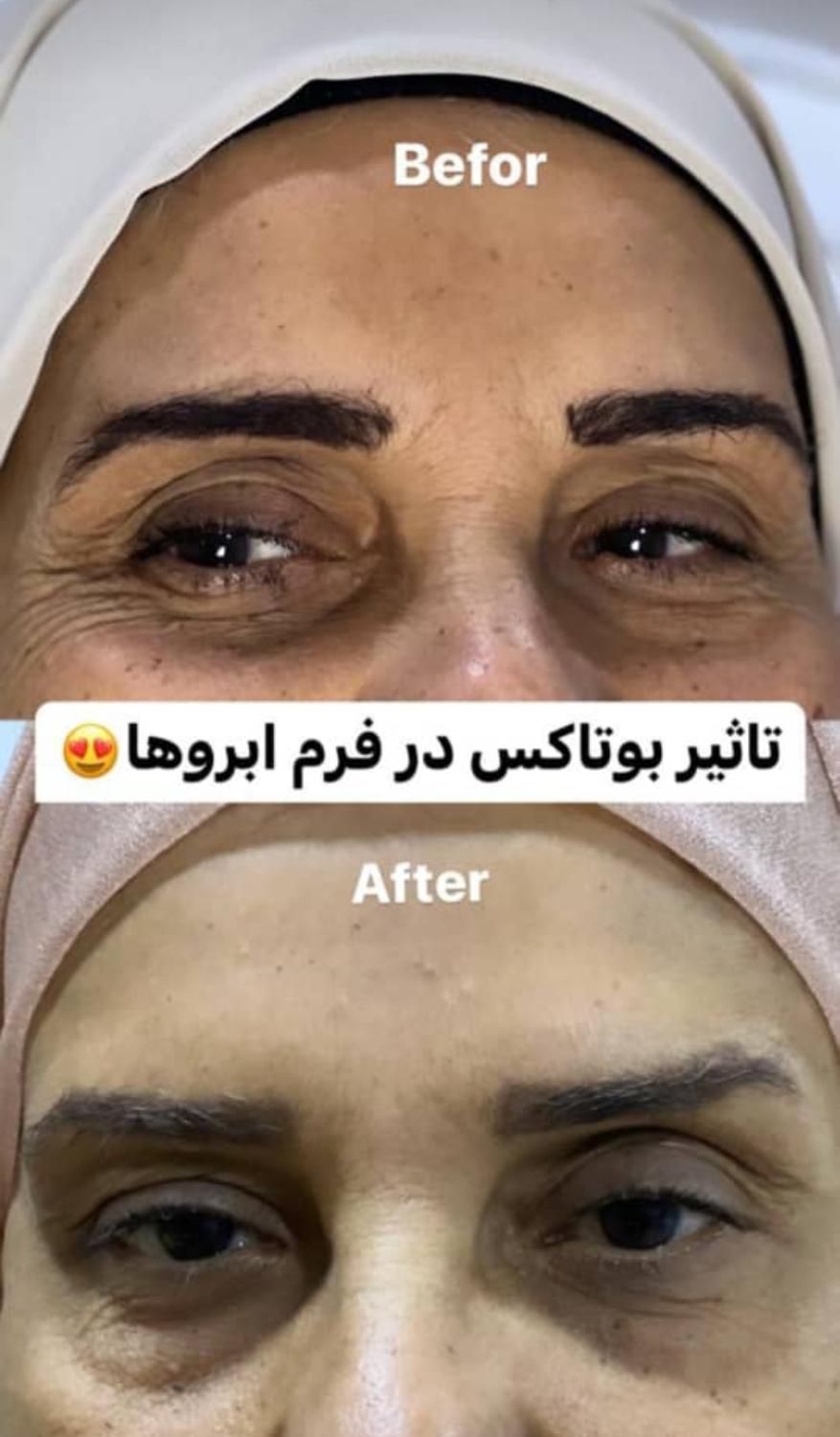 تزریق و آموزش انواع فیلرو بوتاکس|خدمات آرایشگری و زیبایی|مشهد, فرهنگیان (شهرک غرب)|دیوار