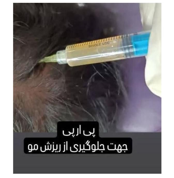 فیلرژل بوتاکس پی ارپی لاغر تزریق چربی مزولیزرهایفو|خدمات آرایشگری و زیبایی|تبریز, |دیوار