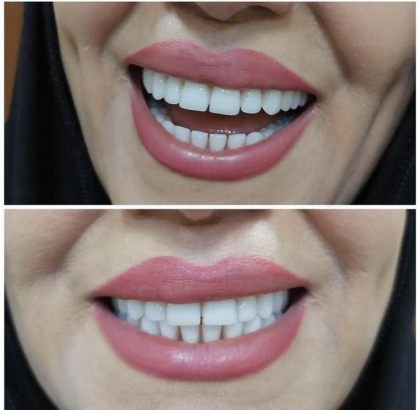 دندان،دندانسازی،اقساطی،دندان مصنوعی،تخفیف|خدمات آرایشگری و زیبایی|مشهد, وکیل‌آباد|دیوار