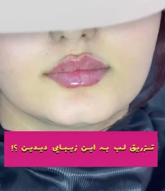 فیلر هایفو لاغری چربی لیزر پی آر پی مزو نخ|خدمات آرایشگری و زیبایی|تبریز, |دیوار
