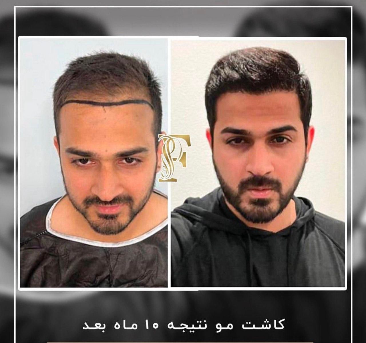 کاشت مو ابرو ریش بدون جراحی با پیشرفته ترین روش|خدمات آرایشگری و زیبایی|تهران, الهیه|دیوار
