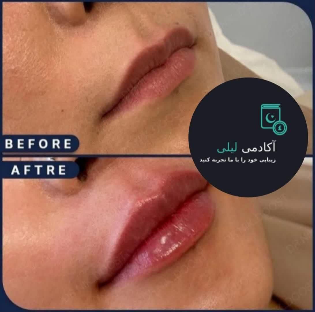 بوتاکس ژل لب زاویه فک.گونه .چانه. پرکردن صورت لاغر|خدمات آرایشگری و زیبایی|قم, زنبیل آباد|دیوار