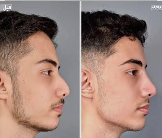 تزریق ژل و بوتاکس و کاشت نخ در کلینیک زیبایی|خدمات آرایشگری و زیبایی|خرم‌آباد, |دیوار