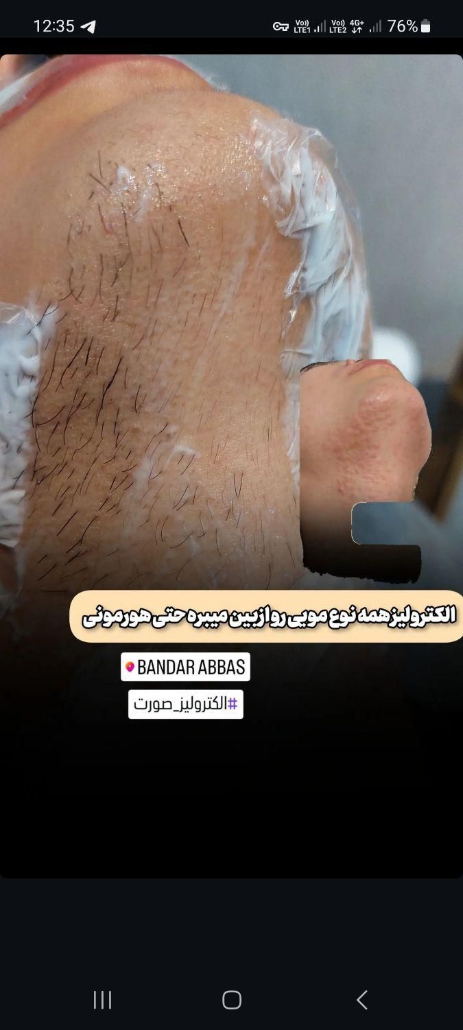 الکترولیز.پیرسینگ.پلاسما.خالبرداری|خدمات آرایشگری و زیبایی|سنندج, |دیوار