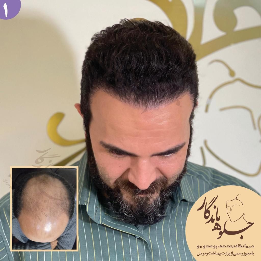 کاشت مو با خط رویش طبیعی و تراکم بالا|خدمات آرایشگری و زیبایی|تهران, عباس‌آباد|دیوار