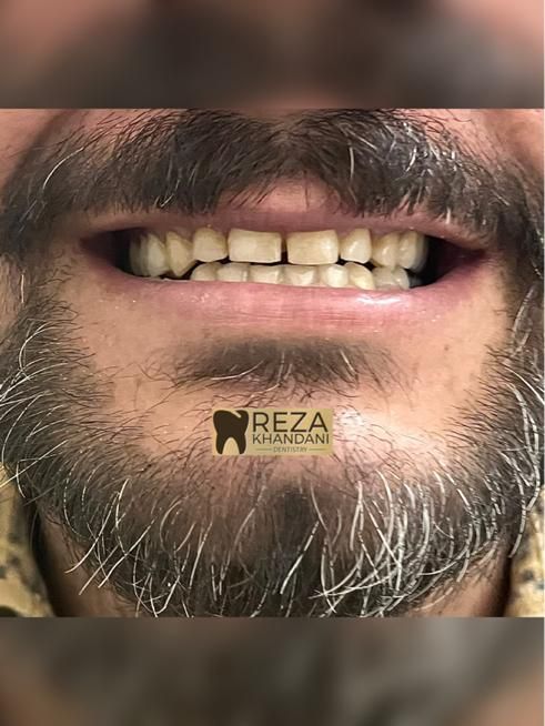 دندان مصنوعی دندانسازی پروتز متحرک|خدمات آرایشگری و زیبایی|مشهد, گلبرگ|دیوار