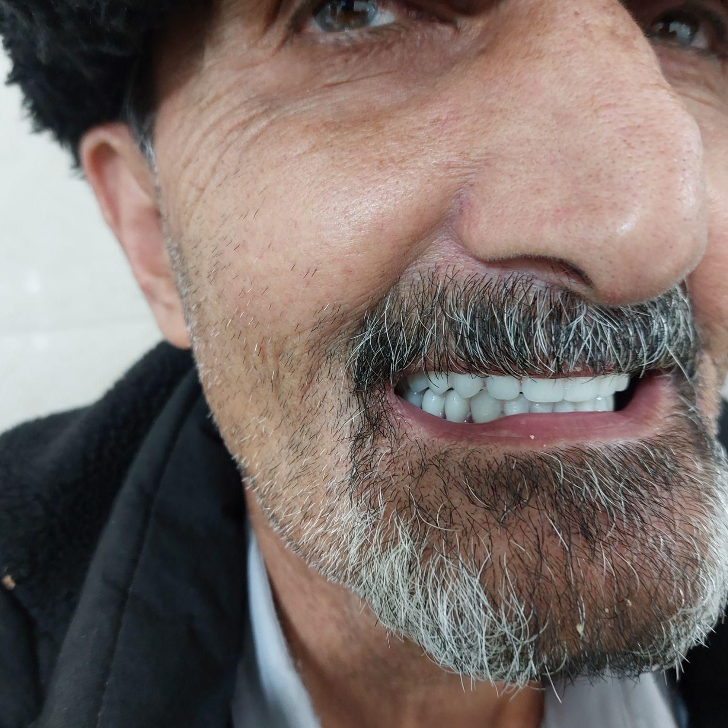 دندانسازی، دندان سازی، دندان مصنوعی، تعمیر شکستگی|خدمات آرایشگری و زیبایی|مشهد, یوسفیه|دیوار