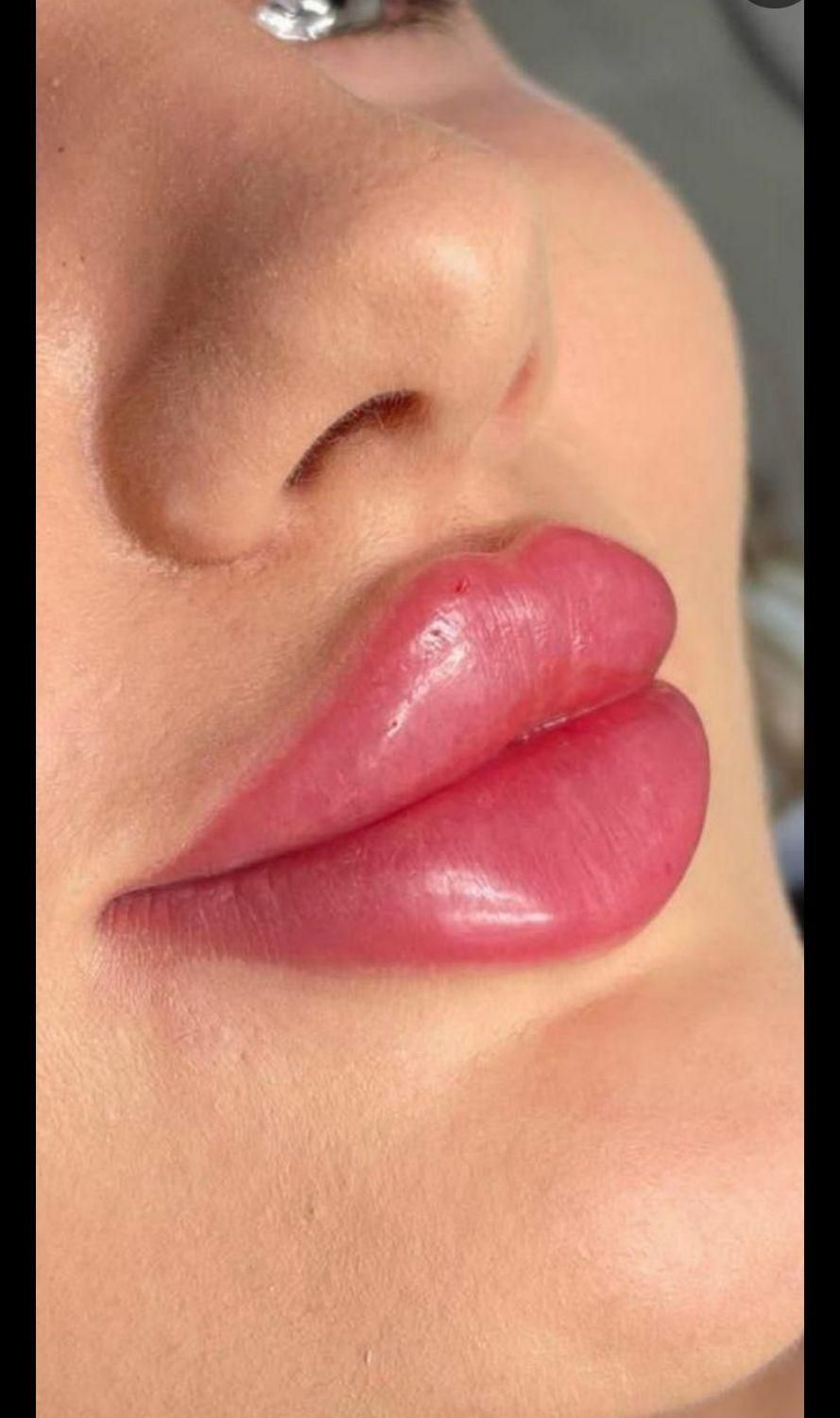 ژل و بوتاکس و لیفت نخ مزوتراپی و آنزیم.فیلربادی|خدمات آرایشگری و زیبایی|کرج, مهرویلا جنوبی|دیوار