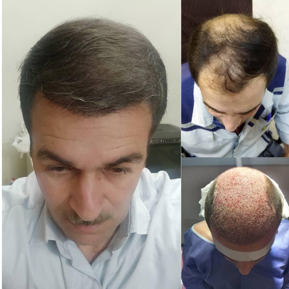 کاشت ابرو وموی طبیعی|خدمات آرایشگری و زیبایی|بوشهر, |دیوار