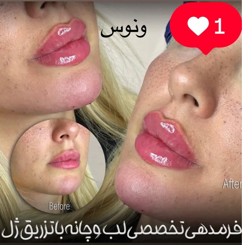 جشنواره50%تزریق ژل390مادلینگ هایفو لیزر مو ‌زائد|خدمات آرایشگری و زیبایی|تهران, ستارخان|دیوار