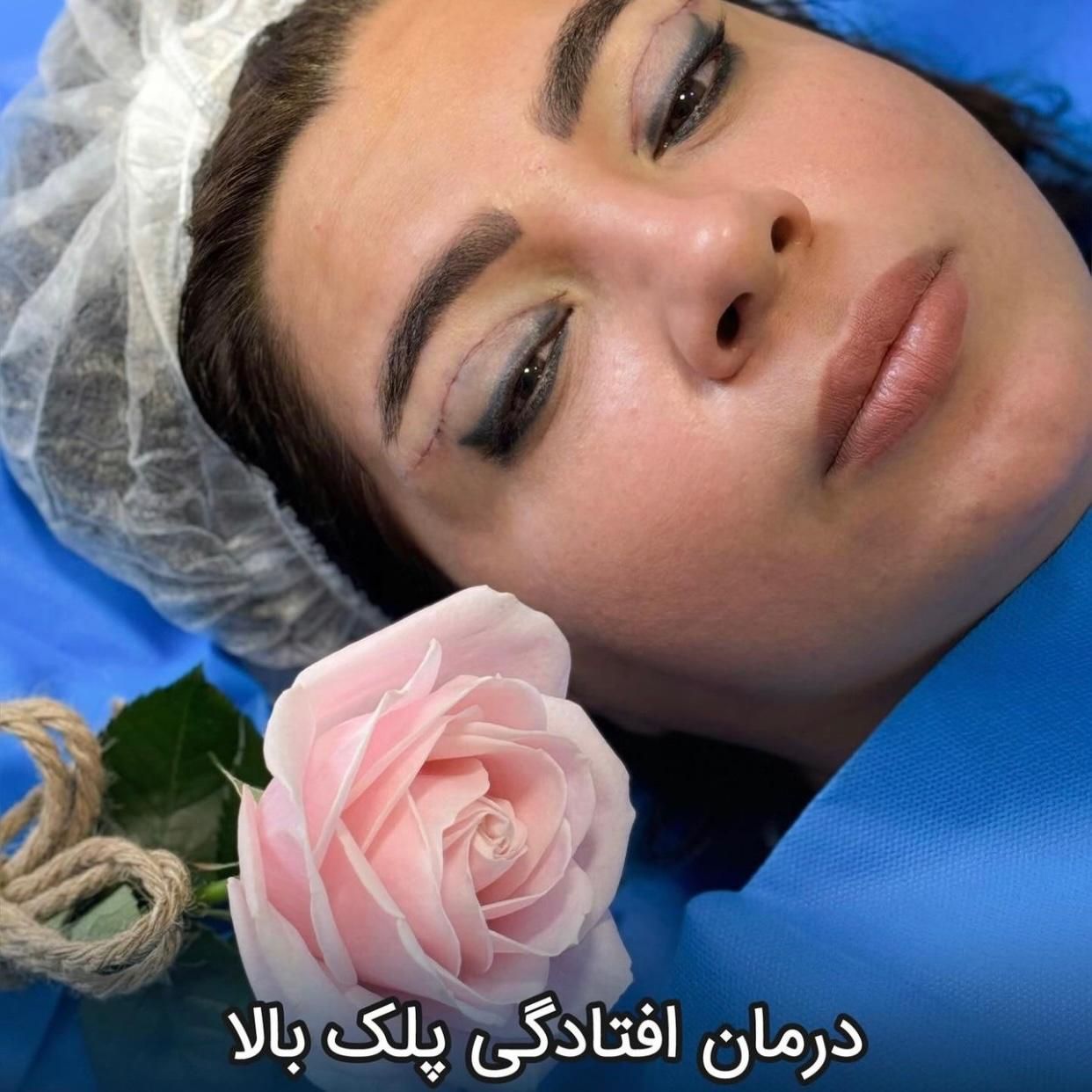 جراحی تخصصی بلفاروپلاستی با تکنیک جدید|خدمات آرایشگری و زیبایی|تهران, پاسداران|دیوار