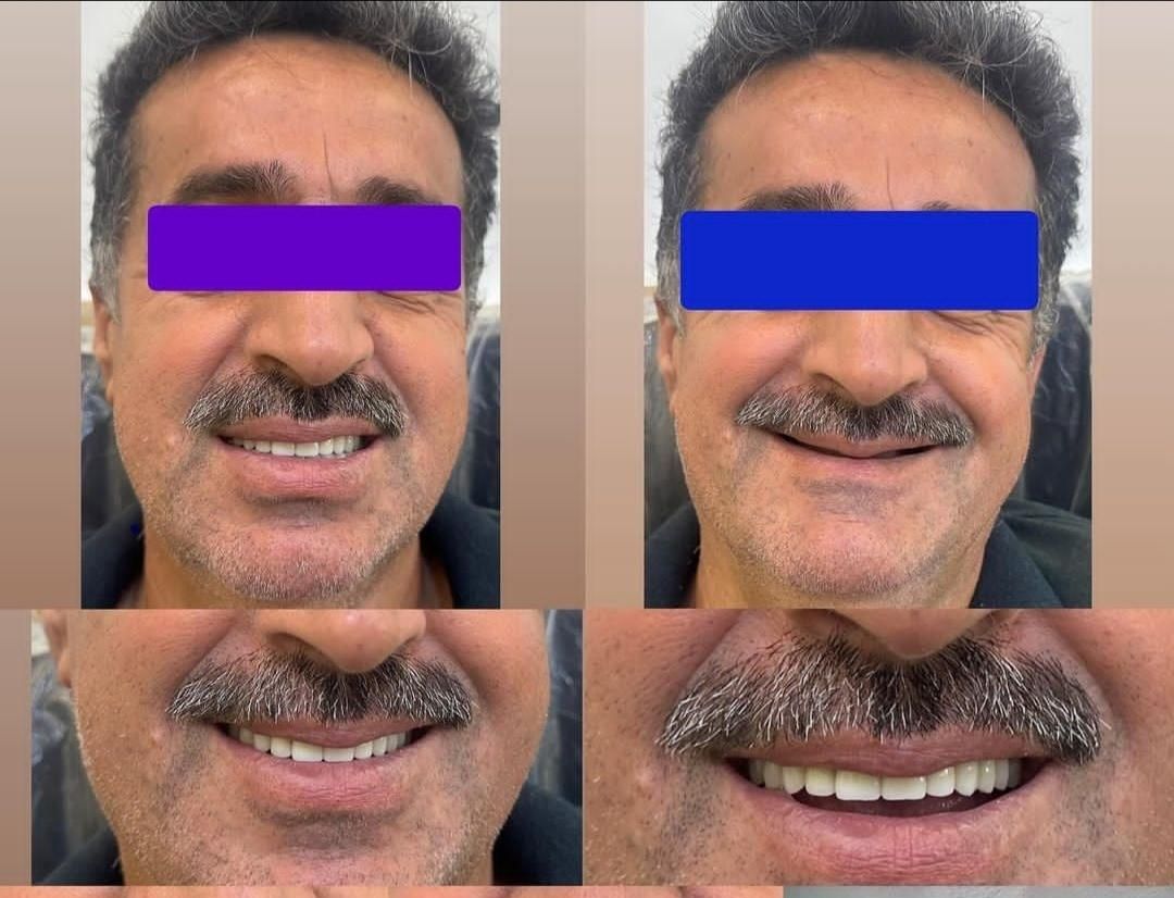 دندانسازی میعاد دندان مصنوعی|خدمات آرایشگری و زیبایی|کرمان, |دیوار