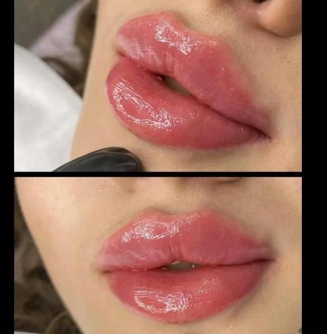 تزریق ژل لب و گونه و چانه و..(جشنواره)درمطب|خدمات آرایشگری و زیبایی|اصفهان, ملک‌شهر|دیوار