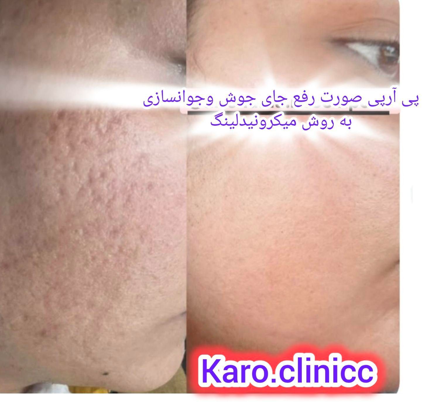 پی آرپی مو وصورت وبوتاکس آف خورده|خدمات آرایشگری و زیبایی|کرمانشاه, |دیوار