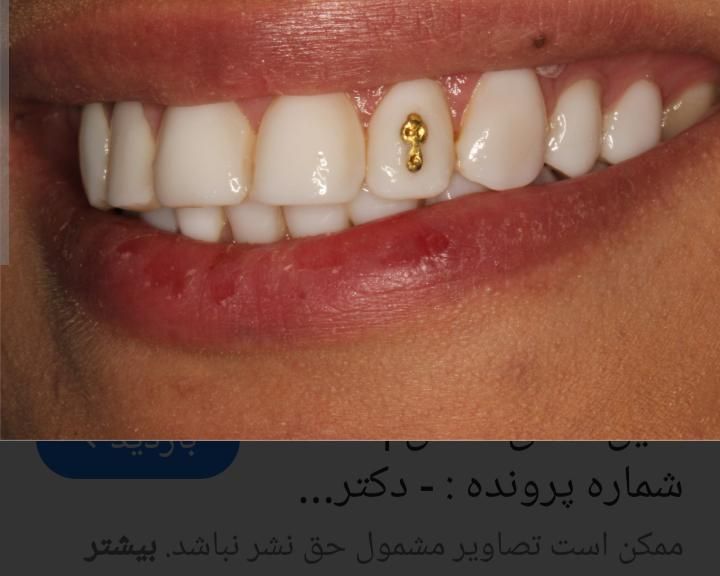 عصب کشی دندان (۱۲۰۰) دندانپزشکی تعرفه دولتی|خدمات آرایشگری و زیبایی|کرج, برغان|دیوار