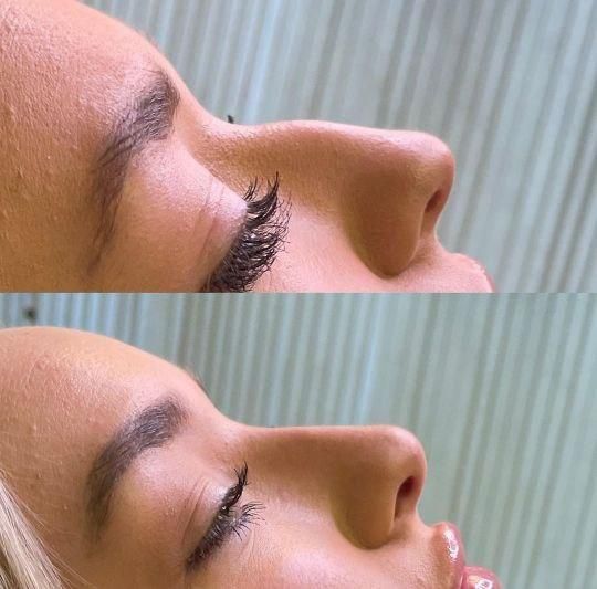 آنزیم ترکیبی بینی، لیفت بینی ژل کانتور صورت لب مزو|خدمات آرایشگری و زیبایی|تهران, سعادت‌آباد|دیوار
