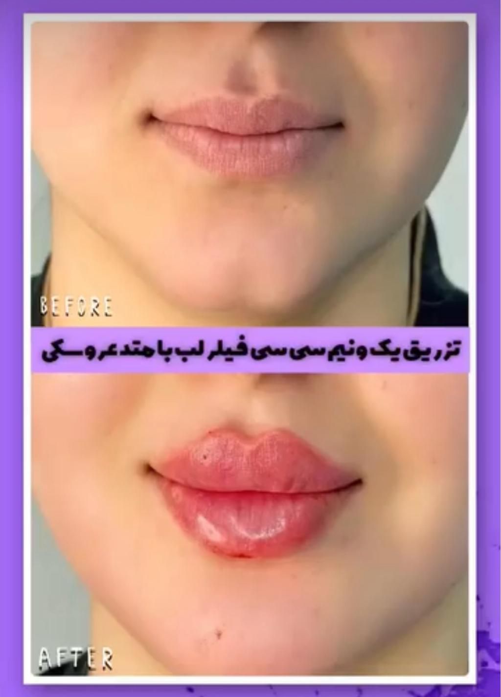 تزریق فیلر ژل بوتاکس هایفو فشیال لیزرکاملا اقساطی|خدمات آرایشگری و زیبایی|اردبیل, |دیوار