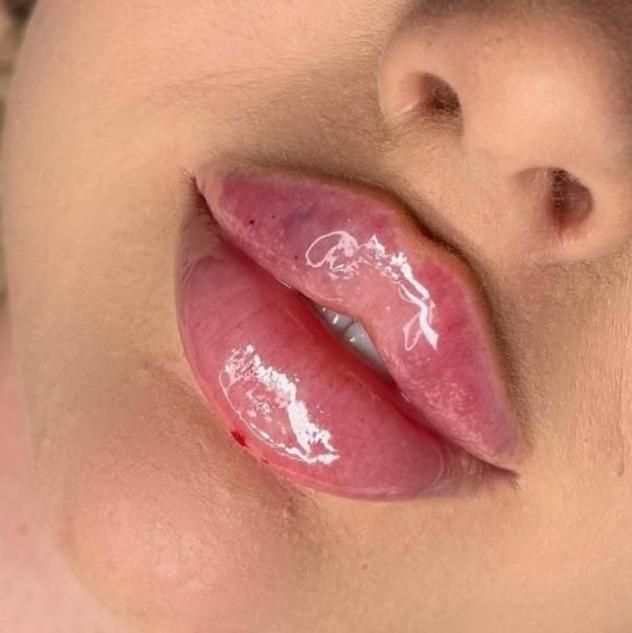 تخفیف ویژه مزو،آنزیم،ژل با بیحسی دندانپزشکی از ۴۰۰|خدمات آرایشگری و زیبایی|گرگان, |دیوار