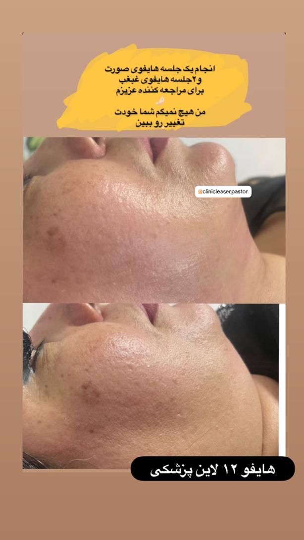 لیزر co2 فراکشنال و هایفوی پزشکی نه رومیزی|خدمات آرایشگری و زیبایی|اهواز, کیانپارس |دیوار